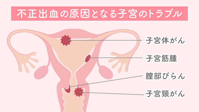 不正出血の原因となる子宮のトラブル（子宮体がん・子宮筋腫・膣部ぶらん・子宮頸がん）