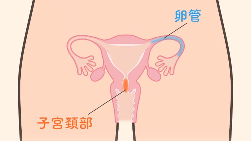 卵管と子宮頚部の炎症を図解