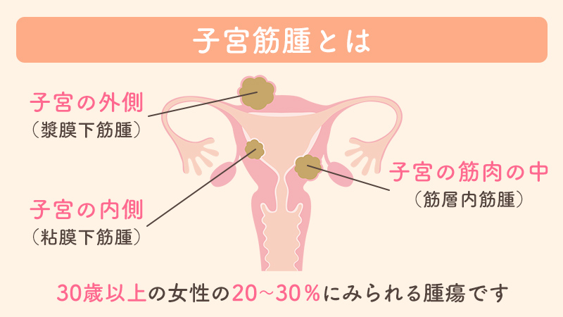 子宮筋腫を図解