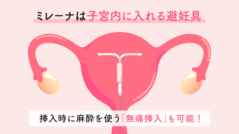 ミレーナは子宮内に入れる避妊具｜挿入時に麻酔を使う「無痛挿入」も可能！